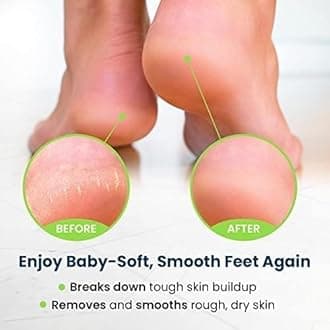 FOOT CURE Exfoliator & Callus Remover Pedicure Set – Care Kit Includes File for Dead Skin, Tea Tree Oil Soak Salts, Urea Cream 40 Percent Removal Gel Made in USA, Ivory, 4 Piece