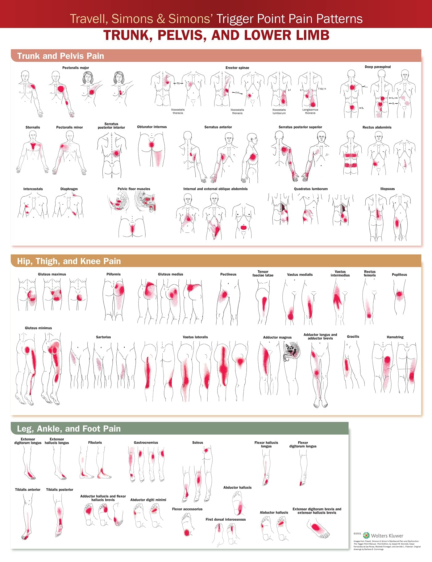 Travell, Simons & Simons Trigger Point Pain Patterns Wall Chart: Trunk, Pelvis, and Lower Limb